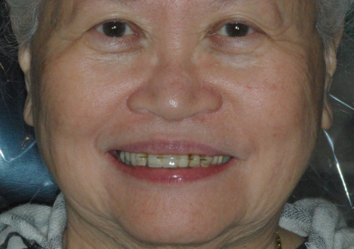 Teeth Xpress (Before)