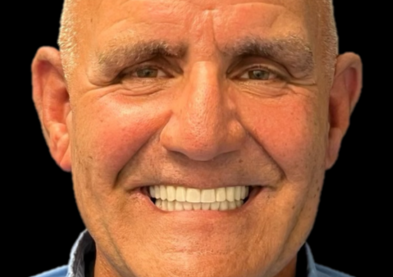 Teeth Xpress (After)