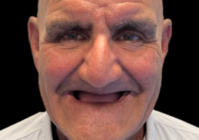 Teeth Xpress (Before)