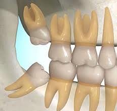 3rd-molar