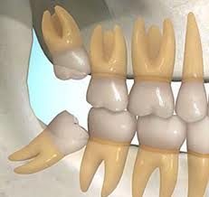 3rd-molar 3rd-molar