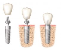 dental-implants dental-implants