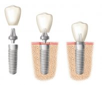 dental-implants